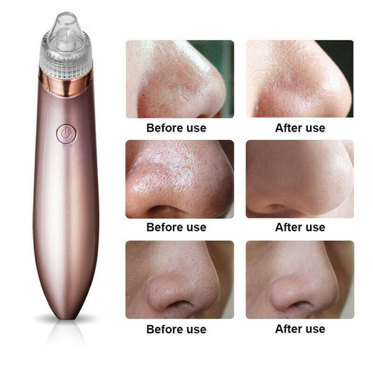 Electric Blackhead Vacuum
